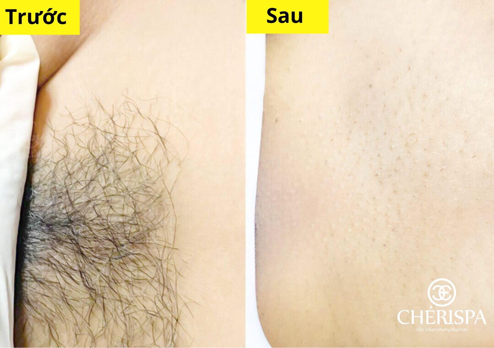 Trước & sau khi triệt lông vùng kín bằng Diode Laser an toàn, hiệu quả duy trì lâu dai, da sáng mịn