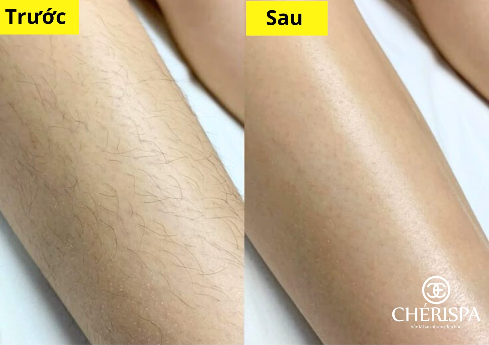 Trước & sau khi triệt lông chân bằng Diode Laser - hiệu quả nhanh, an toàn cho cả da nhạy cảm.