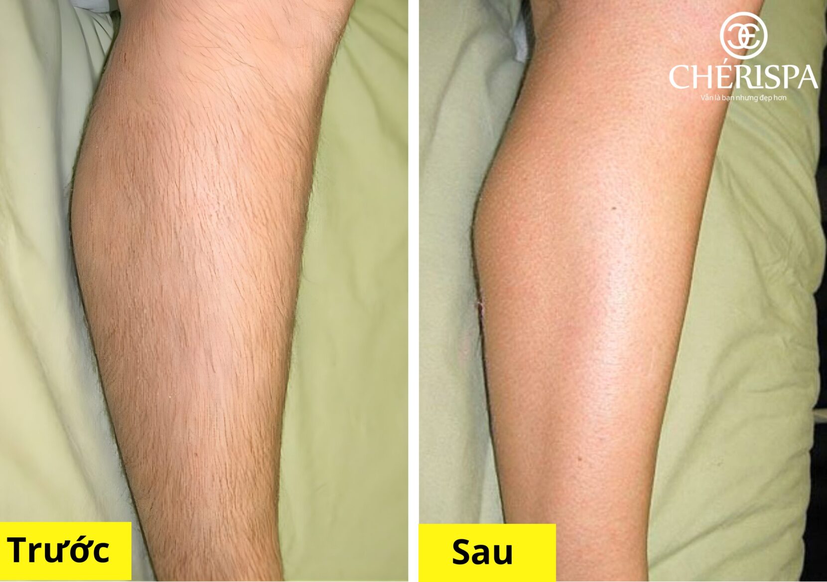Trước & sau khi triệt lông chân bằng Diode Laser - sạch lông, hiệu quả duy trì lâu dài
