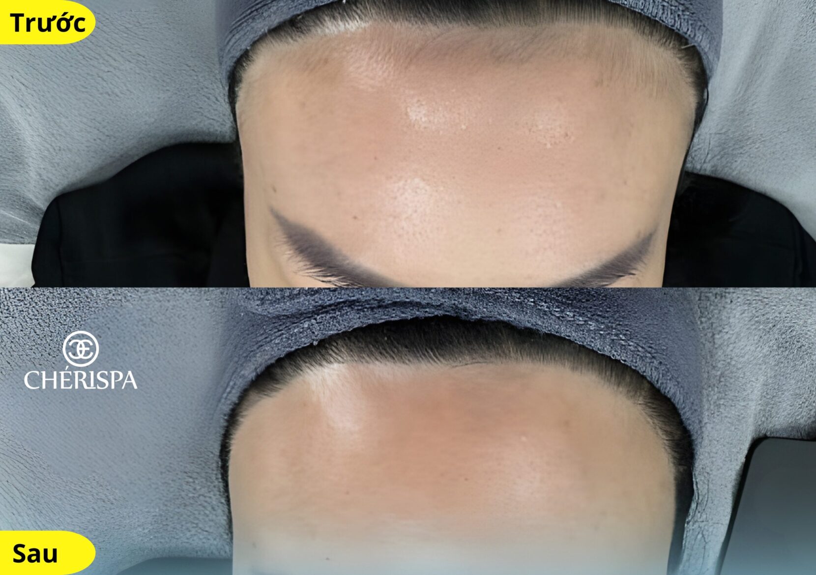 Định hình viền tóc chuẩn từng mm tại Chérispa - Triệt đường chân tóc Quảng Ngãi uy tín