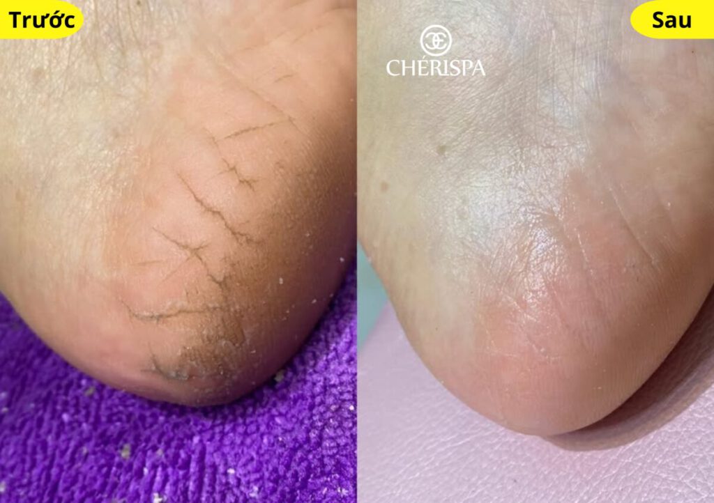 Chà gót chân Quảng Ngãi tại CHÉRISPA - làm mềm da và tăng cường tuần hoàn máu cho đôi chân
