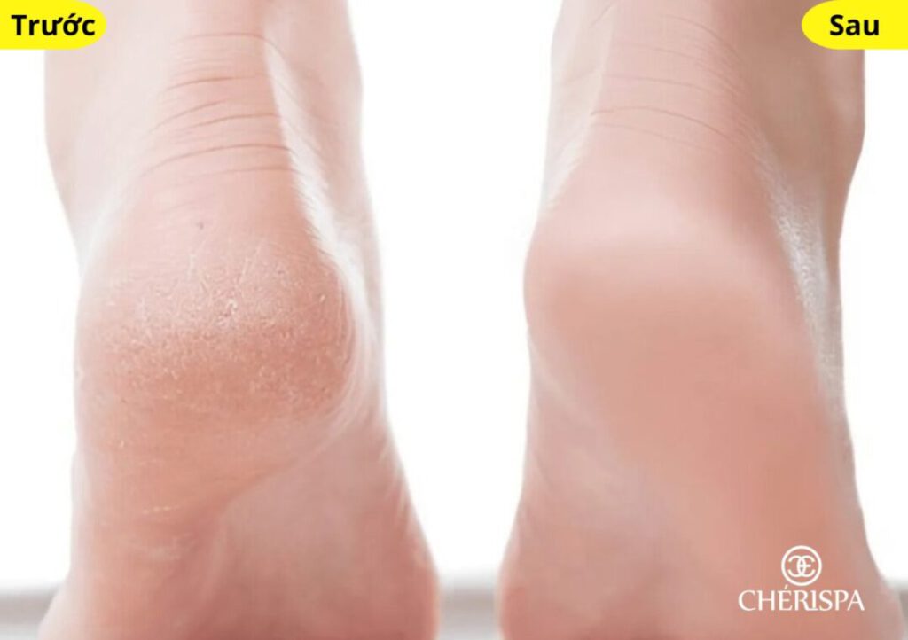 Chà gót chân Quảng Ngãi tại CHÉRISPA giúp da gót chân mềm mại hơn