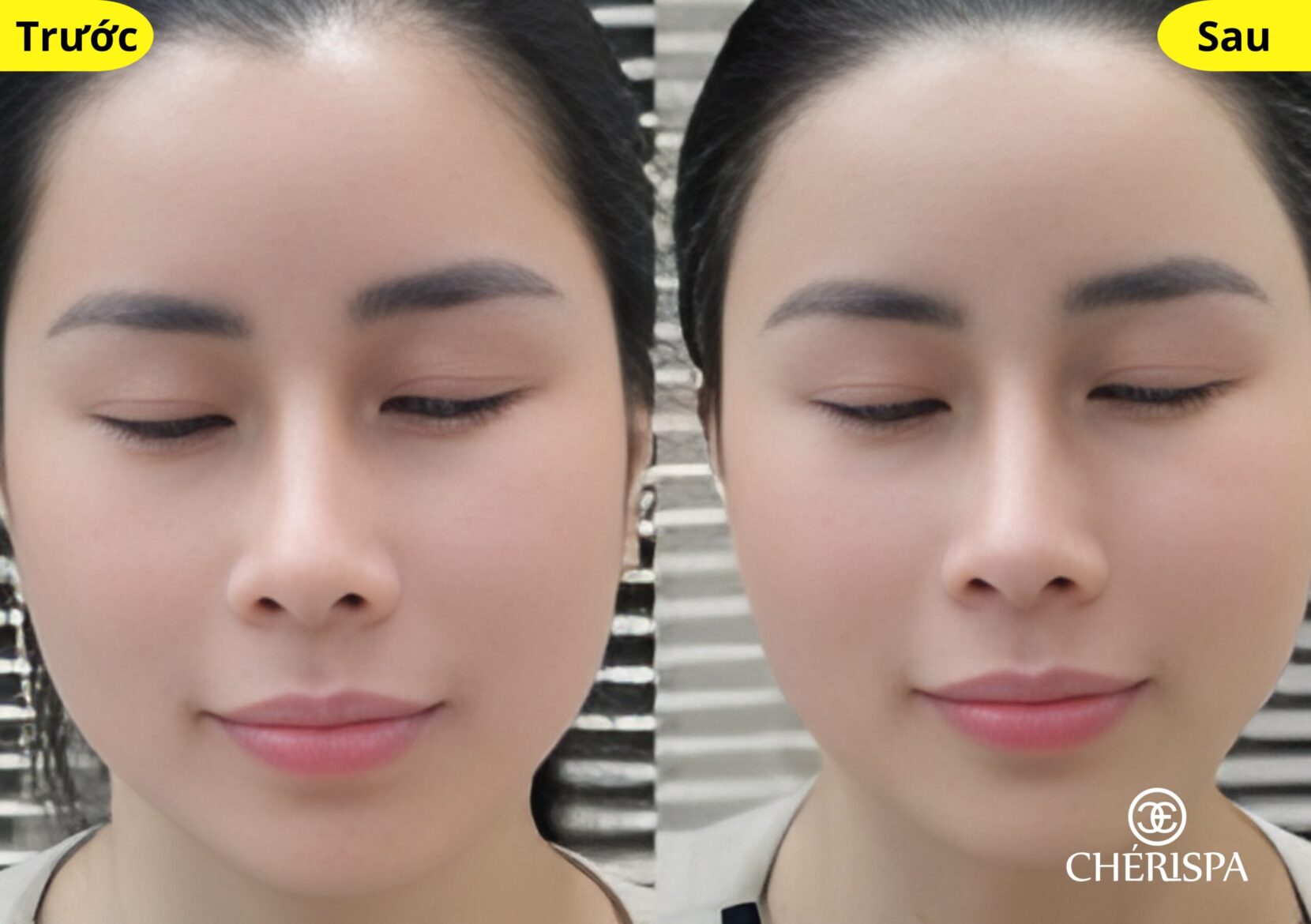 Kết quả trước và sau khi triệt đường chân tóc tại Chérispa - Triệt đường chân tóc Quảng Ngãi uy tín