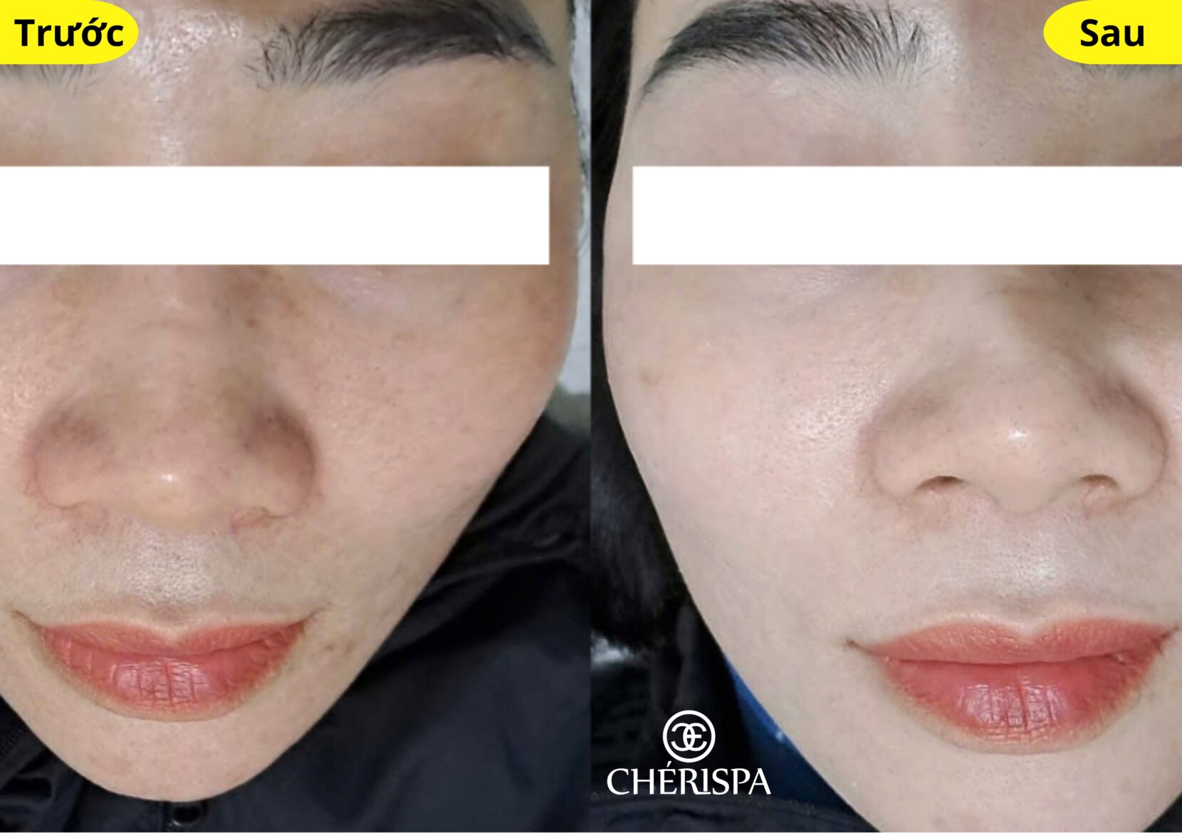 Kết quả trước và sau khi triệt lông mặt tại Chérispa -- Triệt lông mặt Quảng Ngãi uy tín