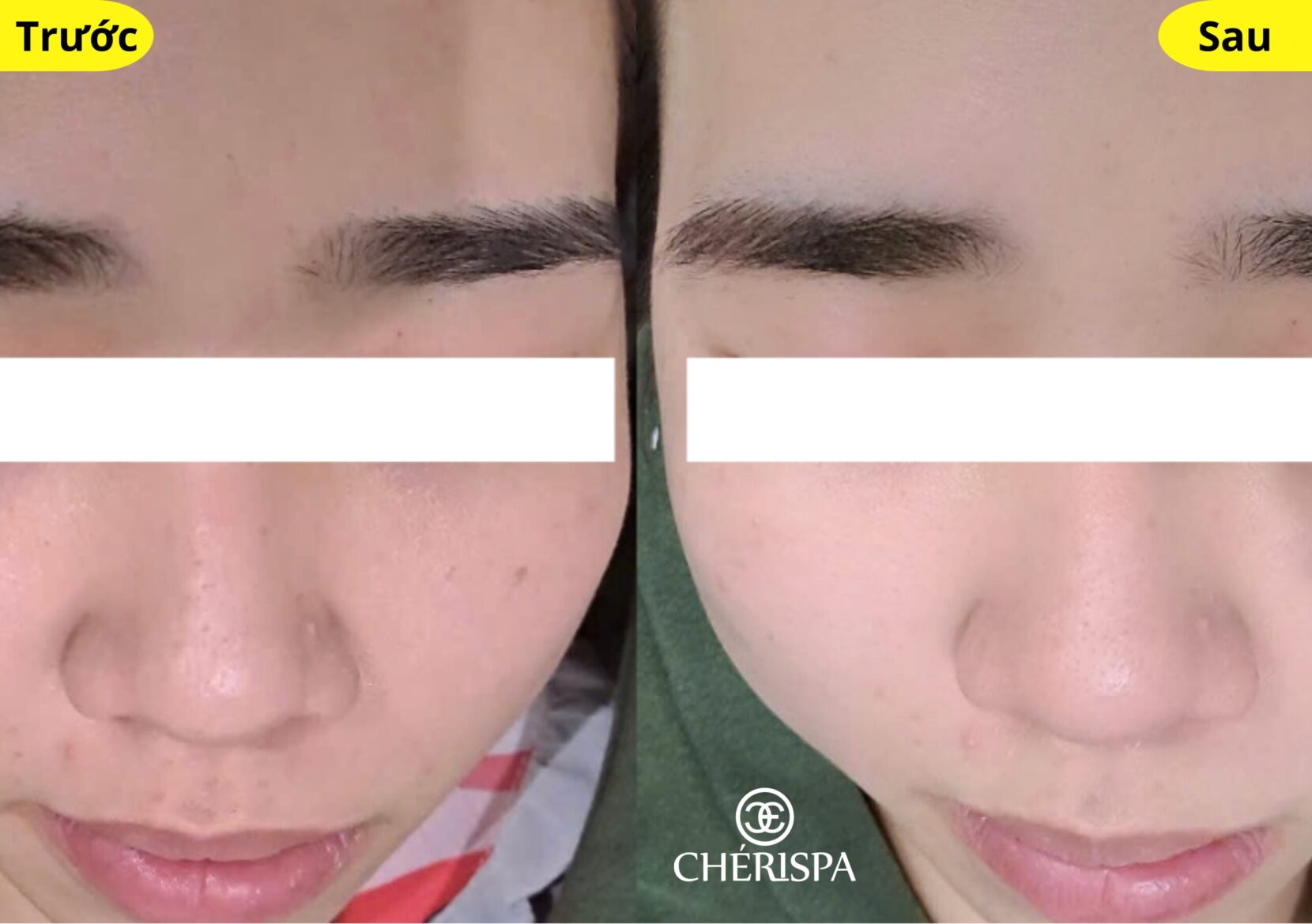 Kết quả trước và sau khi triệt lông mặt tại Chérispa - Triệt lông mặt Quảng Ngãi uy tín