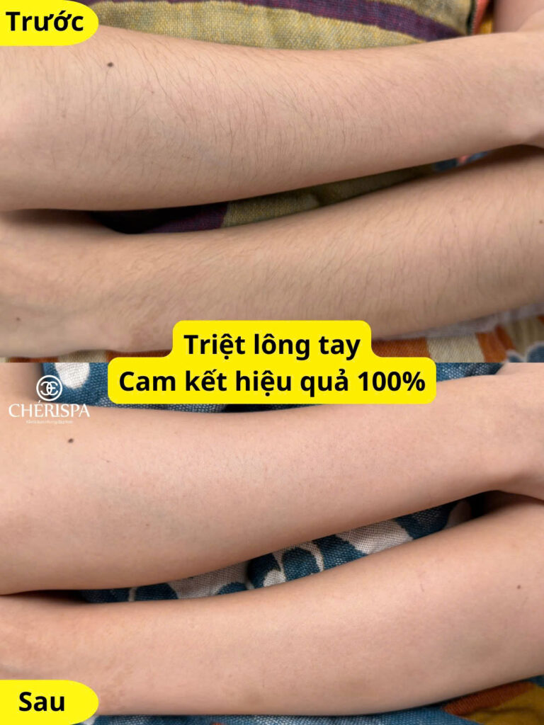 Kết quả trước và sau khi triệt lông tay tại Chérispa -- Triệt lông tay Quảng Ngãi uy tín