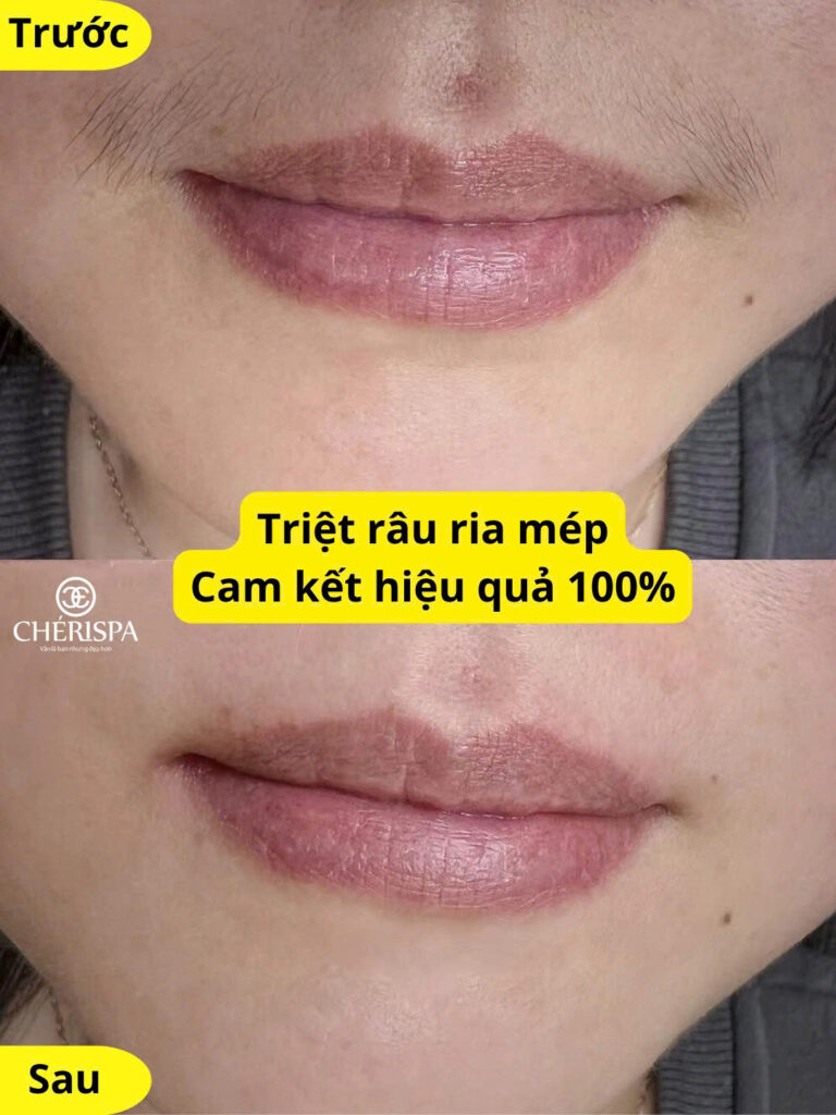 Kết quả trước và sau khi triệt ria mép tại Chérispa -- Triệt ria mép Quảng Ngãi