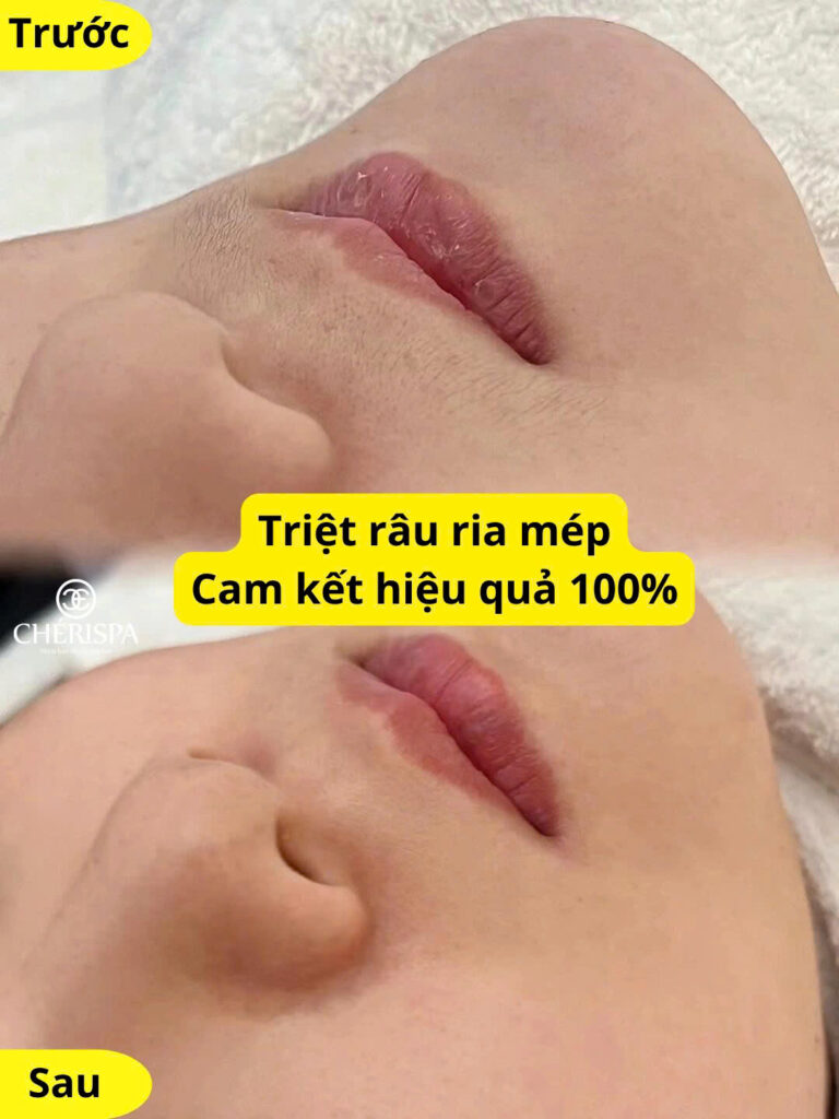 Kết quả trước và sau khi triệt ria mép tại Chérispa - Triệt ria mép Quảng Ngãi