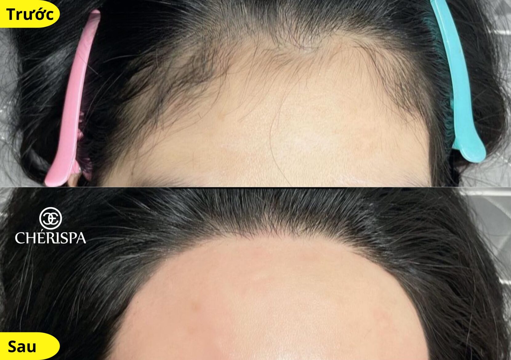 Kết quả trước và sau khi triệt viền chân tóc & tạo hình trán tại Chérispa - Triệt viền chân tóc và tạo hình trán Quảng Ngãi uy tín