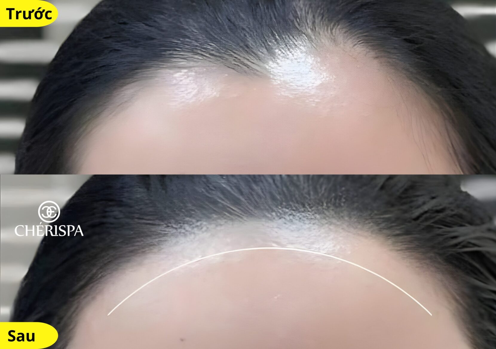 Kết quả trước và sau khi triệt viền chân tóc và tạo hình trán tại Chérispa - Triệt viền chân tóc và tạo hình trán Quảng Ngãi uy tín