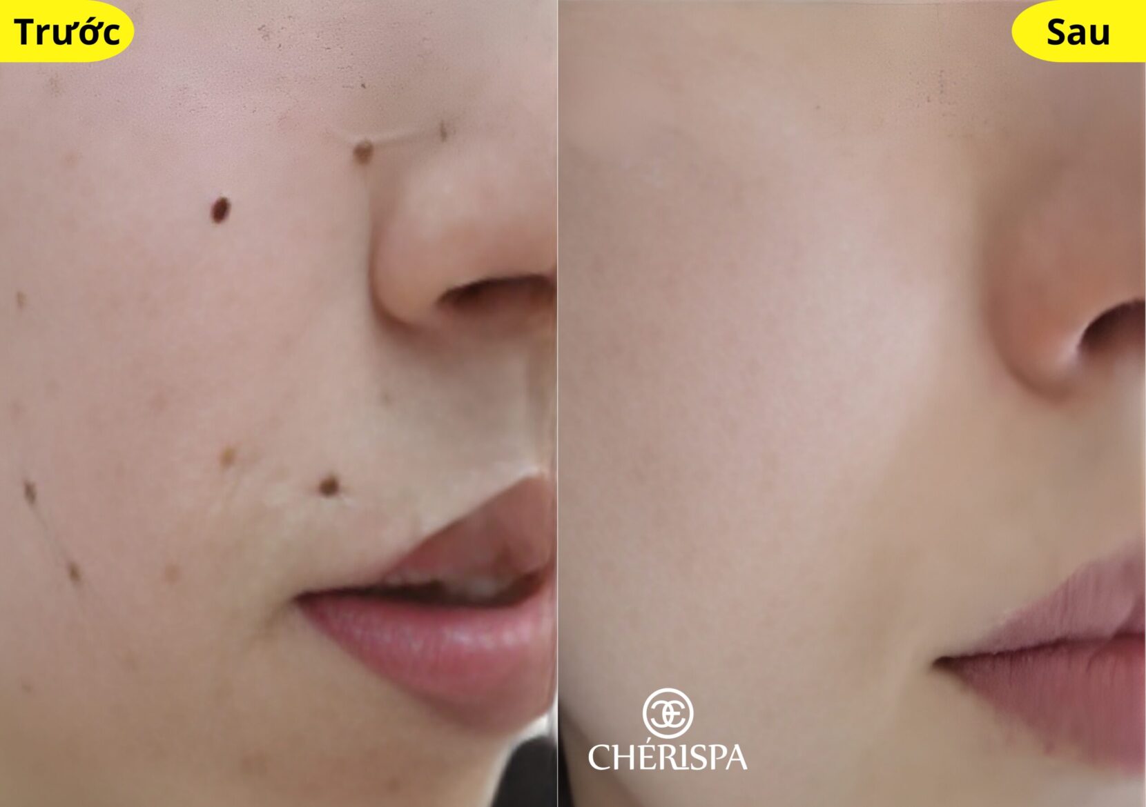 Kết quả trước và sau khi xoá nốt ruồi tại Chérispa -- Xoá nốt ruồi Quảng Ngãi uy tín