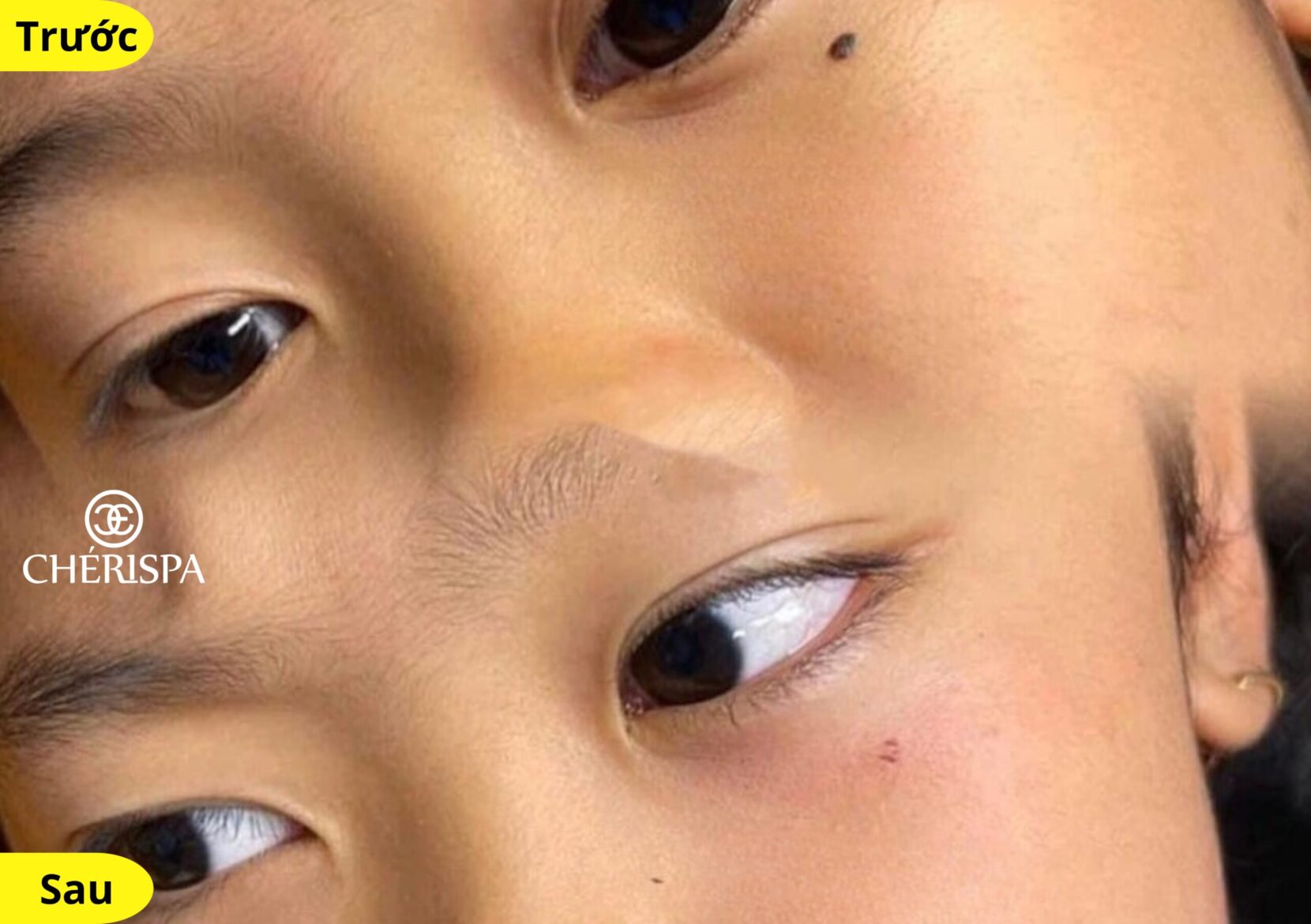 Kết quả trước và sau khi xoá nốt ruồi tại Chérispa - Xoá nốt ruồi Quảng Ngãi uy tín