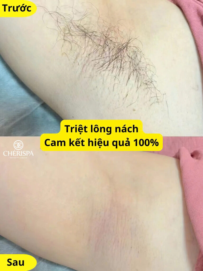 Trước & sau khi triệt nách công nghệ Diode Laser an toàn, hiệu quả nhanh.