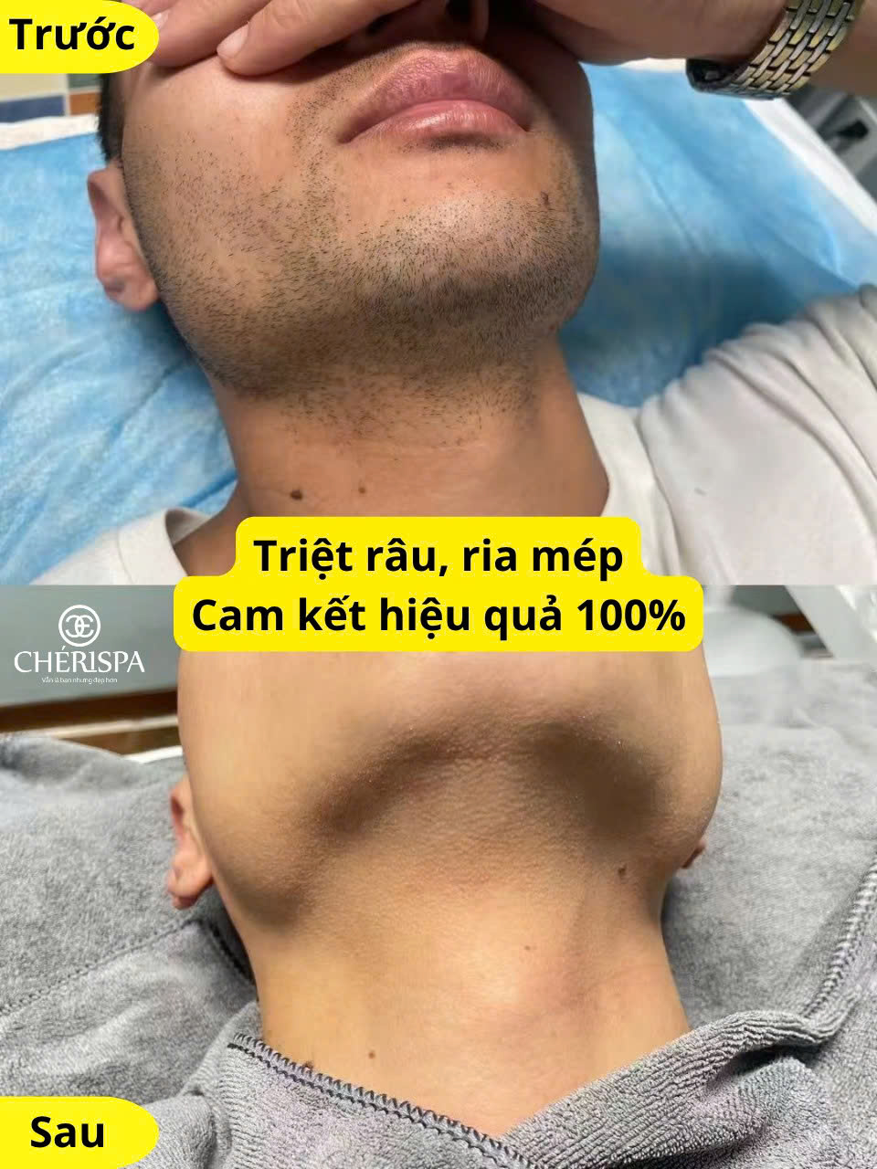 Da mịn màng sau khi Triệt tại Chérispa - Spa triệt râu quai nón Quảng Ngãi