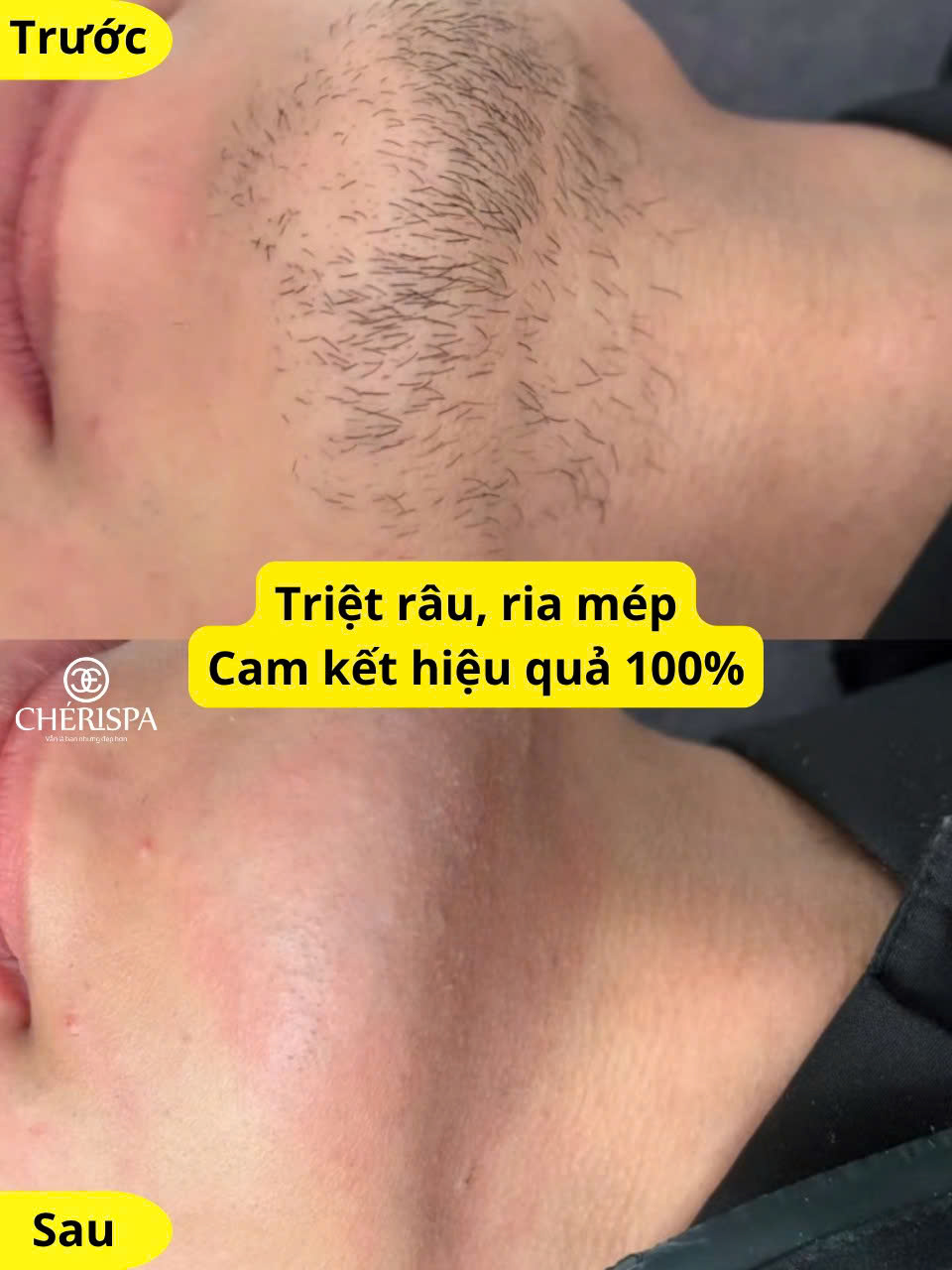 Kết quả sau khi triệt râu tại Chérispa - Triệt râu Quảng Ngãi