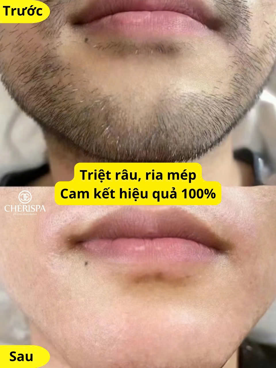 Trước và sau khi triệt râu Diode lazer tại Chérispa - Triệt râu Quảng Ngãi