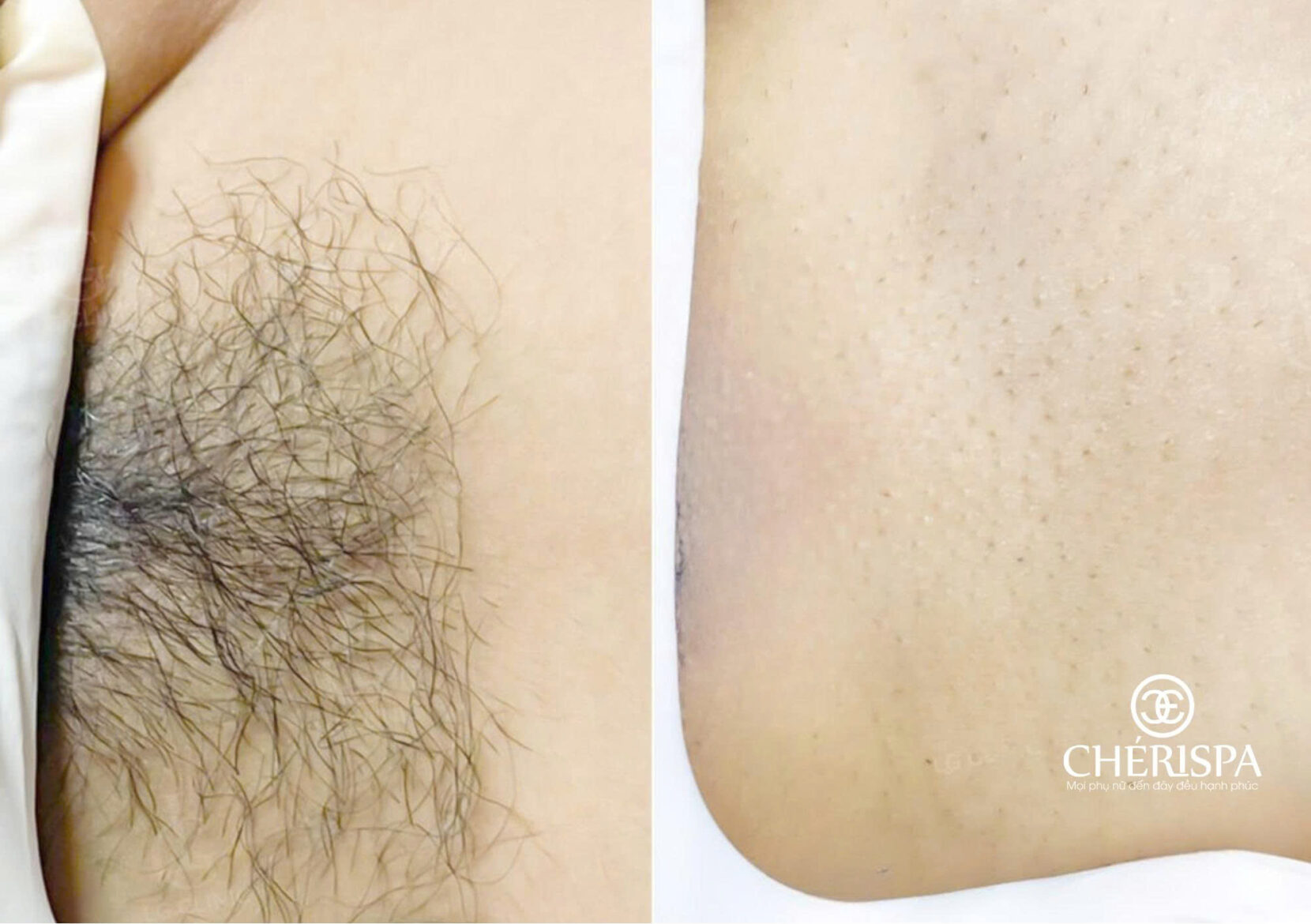 Trước và sau khi triệt lông tại Chérispa - Triệt lông mu Quảng Ngãi